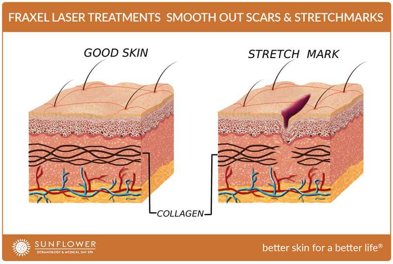 fraxel-laser-treatments-smooth-out-scars-and-strechmarks-sunflower-dermatology