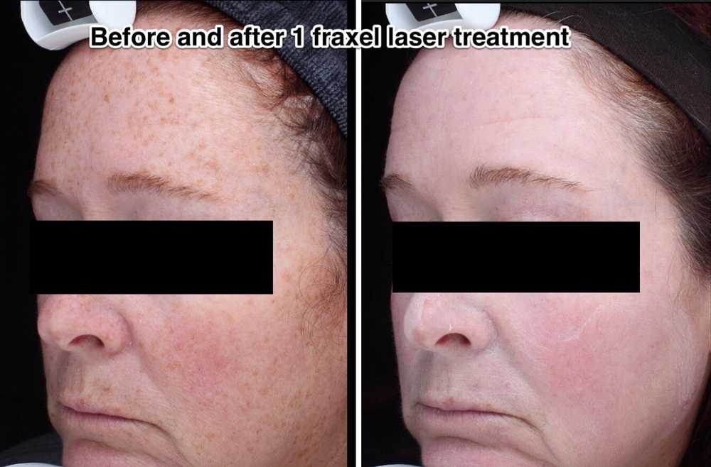 Women's Fraxel before and after