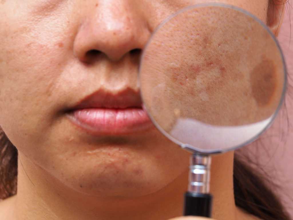 melodramatiske Mekaniker uhøjtidelig Why Do I Have Uneven Skin Tones and Spots on My Skin? - Kansas City  Dermatologists at Epiphany Dermatology